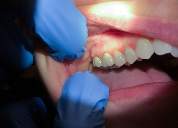 Best Emergency Tooth Extraction in Cascade Locks, OR